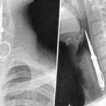 X-ray shows how man accidentally swallowed scissors (Рентгеновские лучи обнаружили случайно проглоченные ножницы)